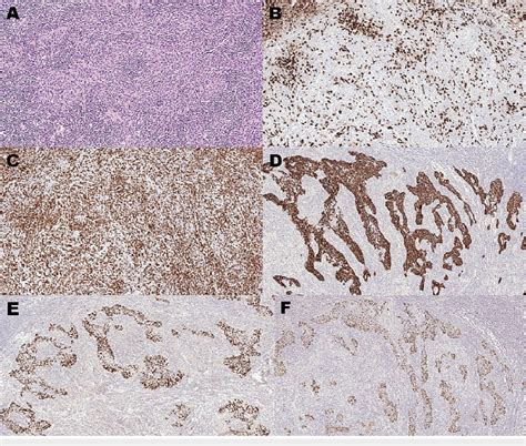 Histological Characteristics Of Lymphoepithelioma Like Carcinoma Of The