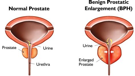 UroLift®System - Five Valleys Urology