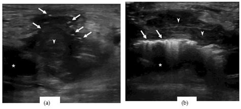 Femoral Artery Ultrasound