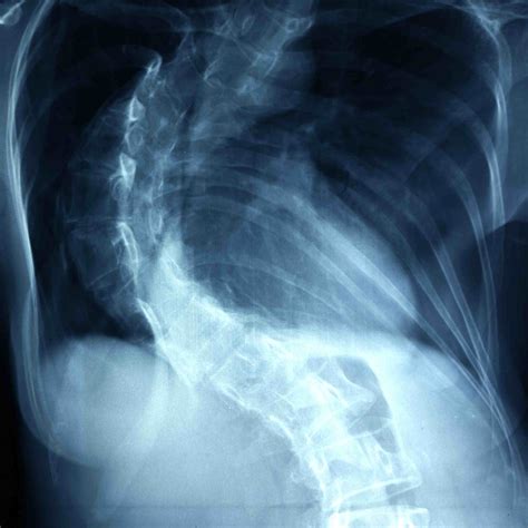 Levoscoliosis And Dextroscoliosis Scoliosis Directions