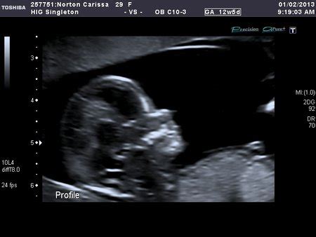 Skull Theory - Boy or Girl? - Expecting a baby - BabyCenter Australia