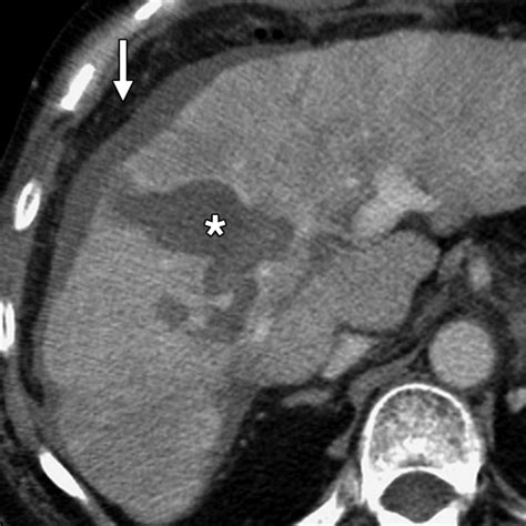 Imaging After Percutaneous Radiofrequency Ablation Of Hepatic Tumors