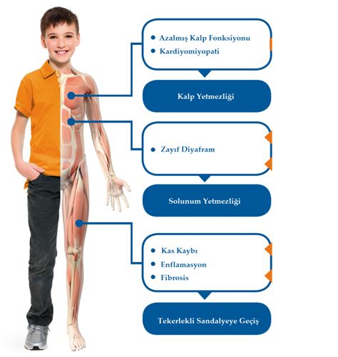 Duchenne Musk Ler Distrofi Dmd Kas Hastal Ve Evde Fizik Tedavi