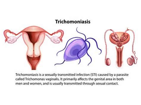 Trichomonas Vaginalis Project Healthcare