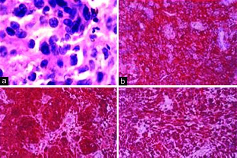 A Pleomorphic Malignant Cells Showing Hyperchromatic Nuclei