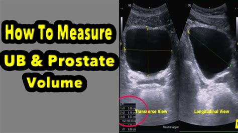 Prostate Anatomy Ultrasound