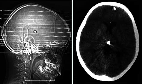 Tomograf A Simple De Cr Neo Con Cuerpo Radiopaco En El Tercer