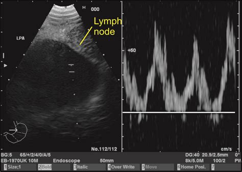 Techniques Of Linear Endobronchial Ultrasound Intechopen