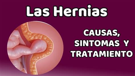 LAS HERNIAS Causas signos y síntomas diagnóstico y tratamiento YouTube