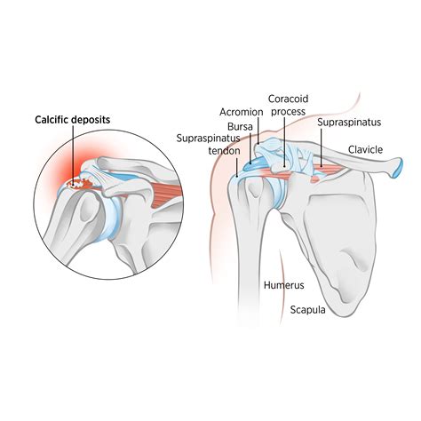 Sports Injury Bulletin Anatomy Calcific Tendonitis Of The Shoulder