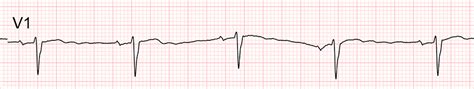 ecg   lead ecg step  step guide