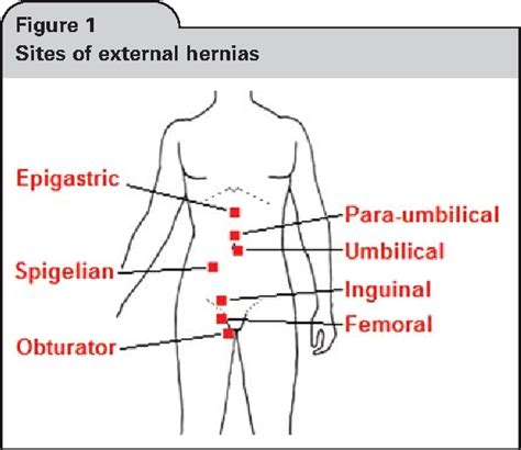 Figure 1 From Nomenclature In Abdominal Wall Hernias Is It Time For