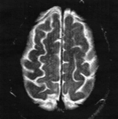 a. Slight hyperintensity at the level of the right perirolandic cortex ...