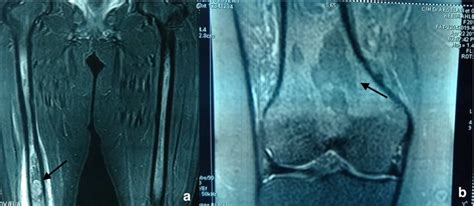 MRI of the femur. Sagittal T1-weighted (a + b) images without... | Download Scientific Diagram