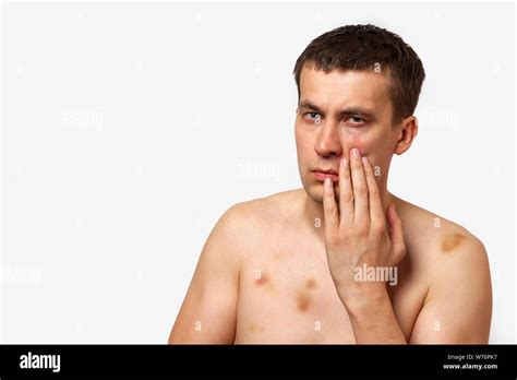Brunette Man With Bruises On His Body Holds His Hand To His Head In Pain After A Fight On A