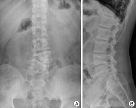 Lumbar Radiographs A Antero Posterior View Showing L Open I