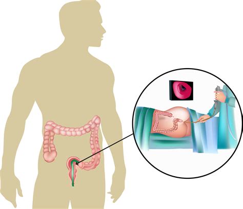 Download A Flexible Sigmoidoscopy Is A Procedure That Examines