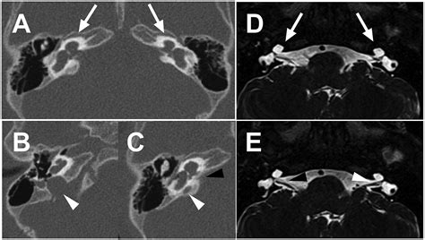 High Riding Jugular Bulb Protruding Into Tympanic Cavity Longitudinal