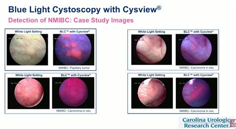 Blue Light Cystoscopy Cost | Shelly Lighting