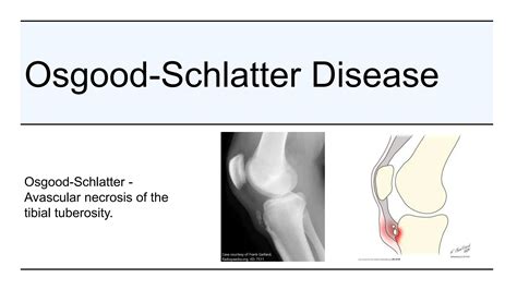 Osteochondritis And Related Diseases Pptx