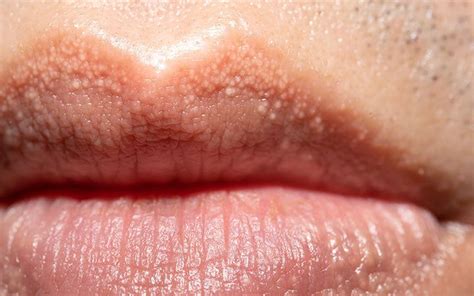 Fordyce Spots On Lips How Does It Look Causes Treatments Vedix