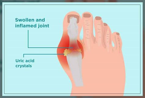 S Uric Acid Normal Range