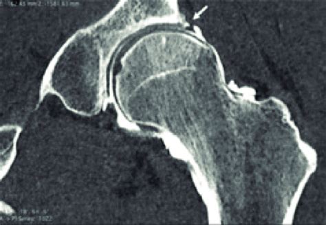 Arthro Ct Shows The Lesion Of The Acetabular Labrum White Arrow