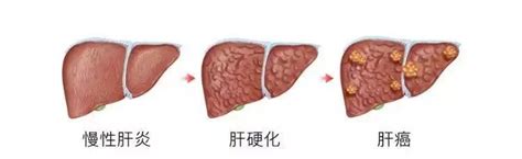 关于肝病三部曲 你需要知道这些 健康教育 嘉兴市第二医院 嘉兴大学附属第二医院