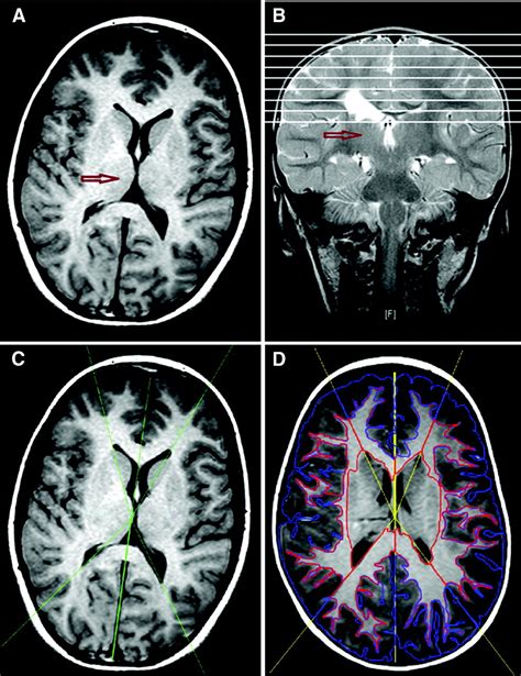 Reduced Ipsilesional Cortical Volumes In Fetal Periventricular Venous Infarction Stroke