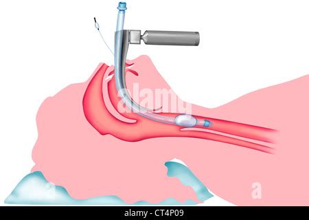 TRACHEAL INTUBATION Stock Photo - Alamy