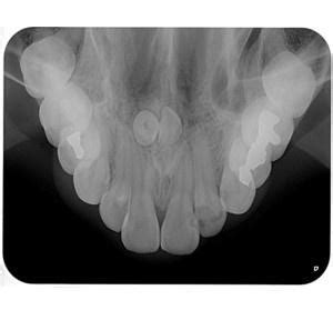 Radiografia Oclusal Precis O Radiologia Odontol Gica Digital