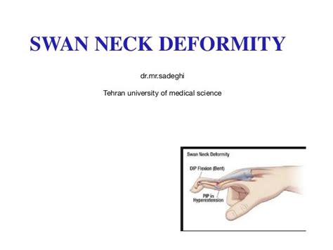 Swan Neck Deformity Causes