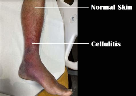 Cellulitis Of The Legs Dr Vivek Baliga By Dr Vivek Baliga B Issuu