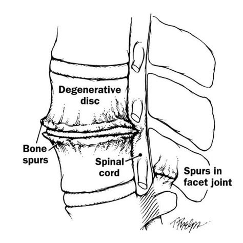 Degenerative Disc Disease Treatment | Johns Hopkins Department of ...