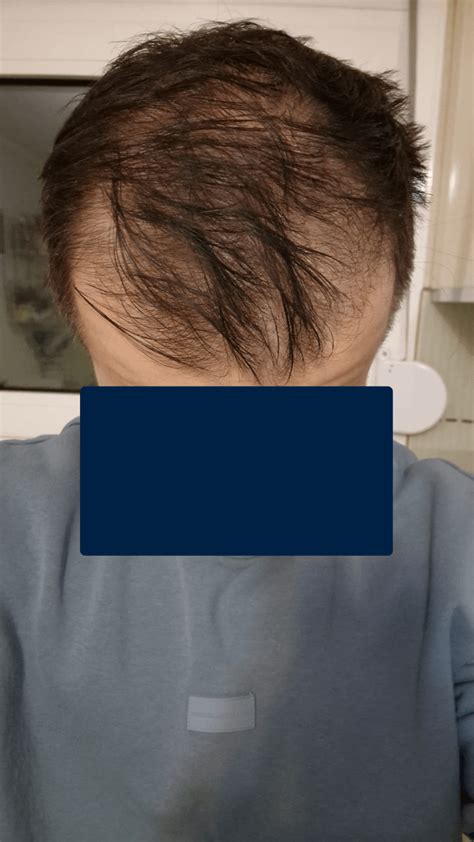 10 months topical Minoxidil %5 results : r/tressless