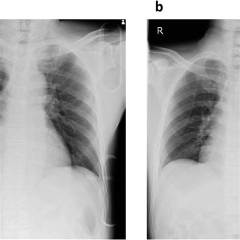 (a) Chest X-ray on admission showed no evidence of hemothorax. (b ...