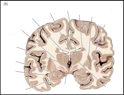 Coronal Section Thalamus Diagram Quizlet