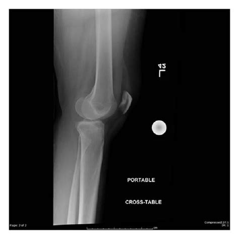 Mri Of Left Knee Showing Popliteofibular Ligament Tear And Edema In