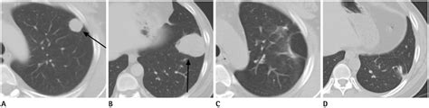 Prognostic Factors For Improved Survival After Pulmonary Metastasectomy