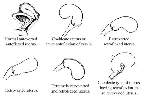 The Retroverted Uterus And Pregnancy Gazala Khan