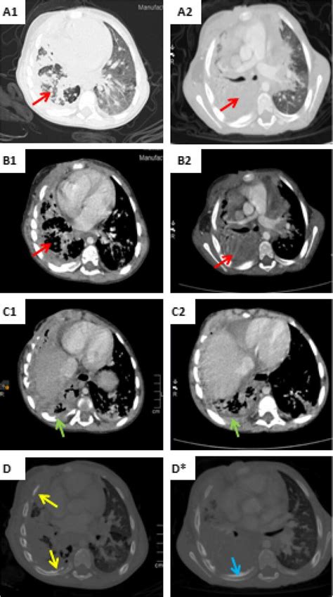 Chest Ct Scans Three Months Apart A A B B And C C