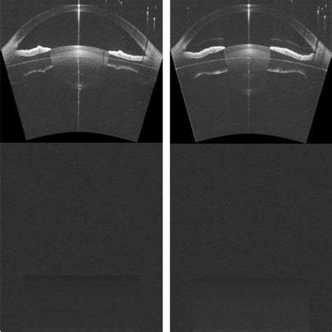 Whole Eye Segment Imaging With Dual Band Sd Oct In A Myopic Eye −20