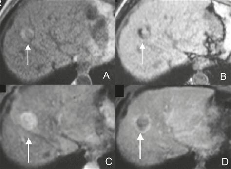 Scielo Brasil Fat Containing Liver Lesions A Pictorial Review Fat