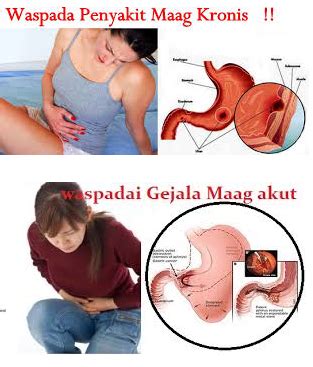 Apa Obat Penyakit Maag Akut Alami