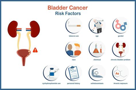 Medical Vector Illustration In Flat Style Infographic Bladder Cancer Risk Factors Such As