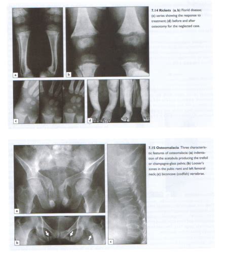 Osteomalacia And Rickets Flashcards Quizlet