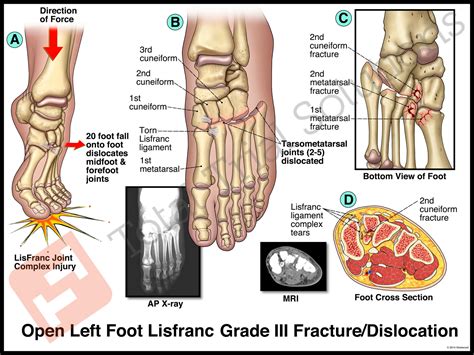 Lisfranc Fracture – Total Trial Solutions