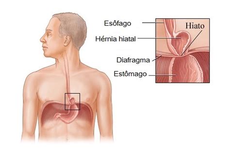 Onde Dói A Hérnia De Hiato - A hérnia de hiato: será que ela tem cura? - Melhor com Saúde