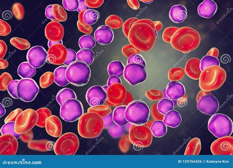 Leucemia Lymphoblastic Aguda Ilustra O Stock Ilustra O De C Ncer