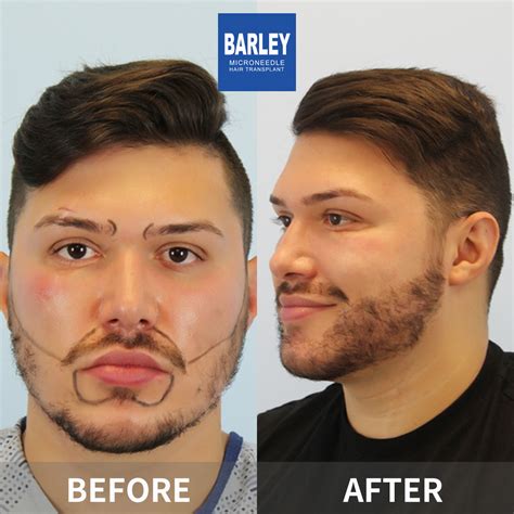 Beard Transplant Results: Transform Your Look with Natural and Impressive Beard Growth